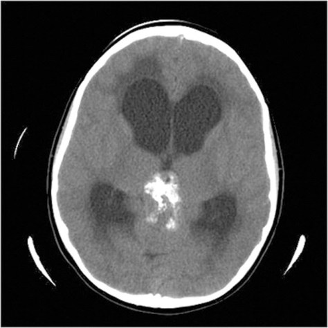 pineal-calcification